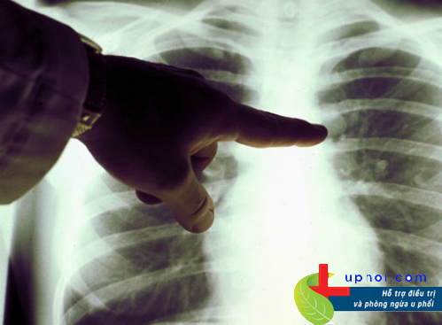 U phổi ác tính là bệnh khó phát hiện sớm