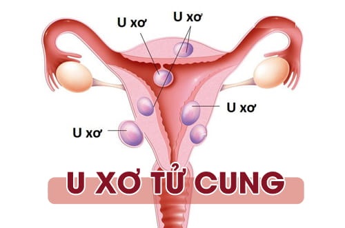    U xơ tử cung – bệnh phụ khoa phổ biến ở nữ giới tuổi sinh sản