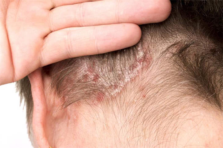 Bệnh vảy nến thường xuất hiện trên da đầu