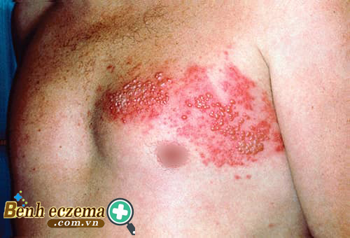  Hình ảnh bệnh viêm da tiếp xúc bội nhiễm
