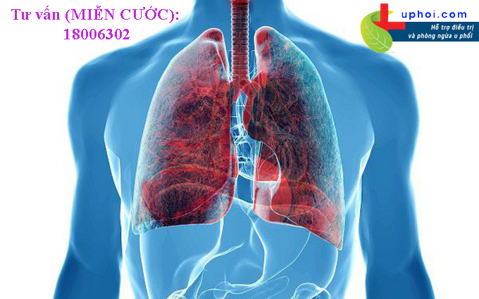 Ung thư phổi là bệnh đang ngày càng có xu hướng tăng nhanh