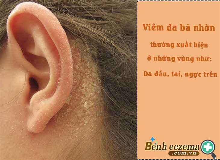 Viêm da bã nhờn thường xuất hiện ở những vùng như: Da đầu, tai, ngực trên,...