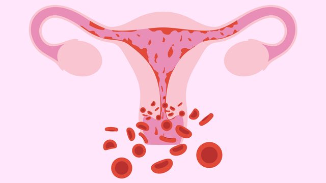    Chảy máu bất thường – dấu hiệu polyp tử cung