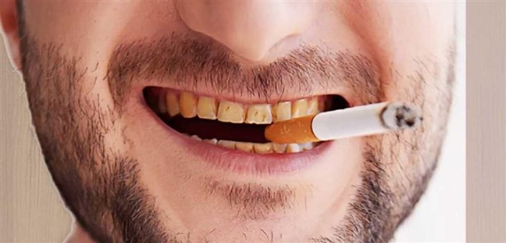   Hút thuốc lá làm tăng nguy cơ bị viêm chân răng