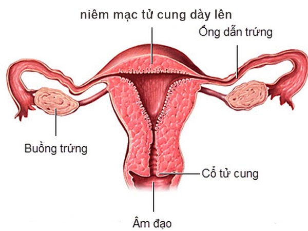 Độ dày niêm mạc tử cung phân thành 3 giai đoạn