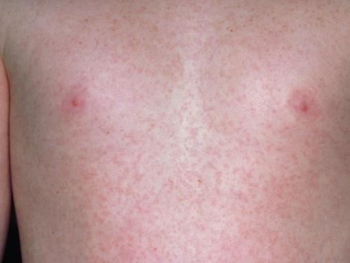    Biểu hiện phát ban trên da của trẻ khi bị virus xâm nhập