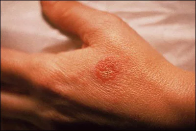 Bệnh chàm tay xảy ra khiến tay bị ngứa và khô