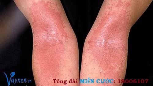 Viêm da dị ứng là dạng phổ biến nhất của bệnh eczema