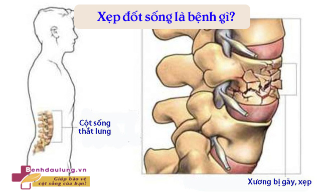 xep-dot-song-la-benh-gi