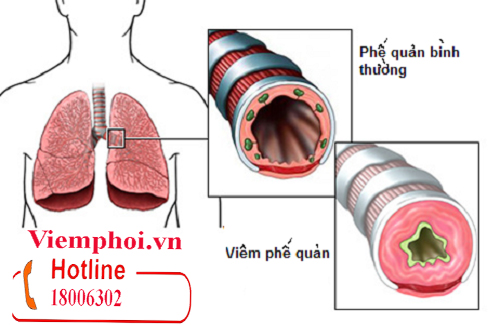 Viêm, nhiễm trùng lâu ngày làm cho phổi, phế quản tăng sinh, tái cấu trúc