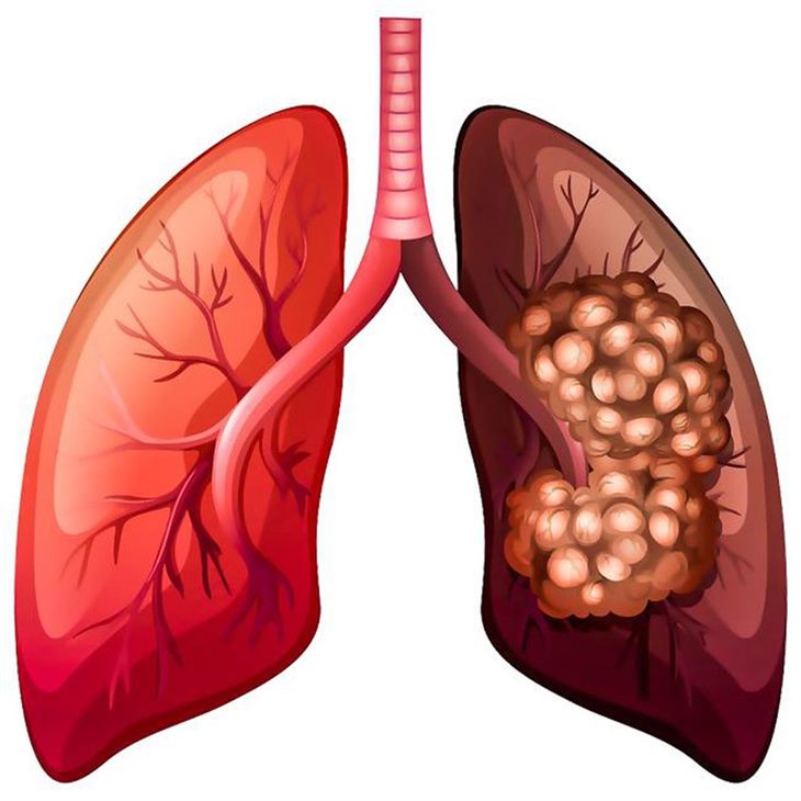 Ung thư phổi chia làm 2 loại chính 