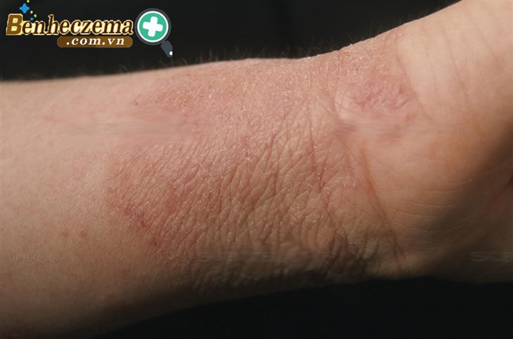  Eczema là bệnh lý mạn tính