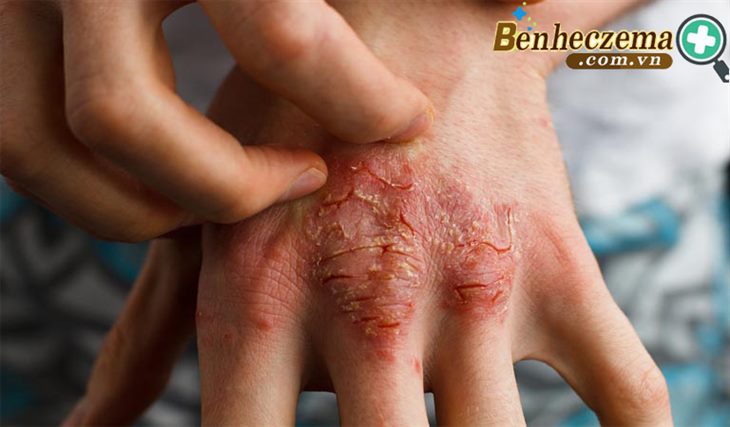  Hình ảnh bệnh eczema