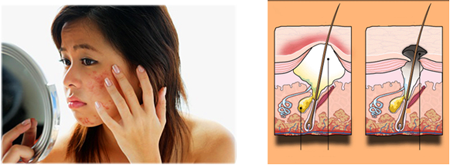   Hormon ảnh hưởng đến quá trình hình thành mụn viêm dưới da