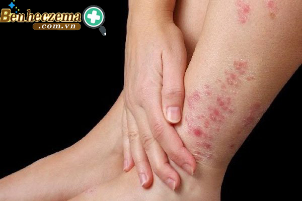  Ngứa ngáy là triệu chứng điển hình của bệnh chàm