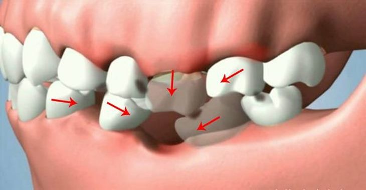 Viêm lợi, viêm quanh răng khiến nhiều người bị rụng răng sớm