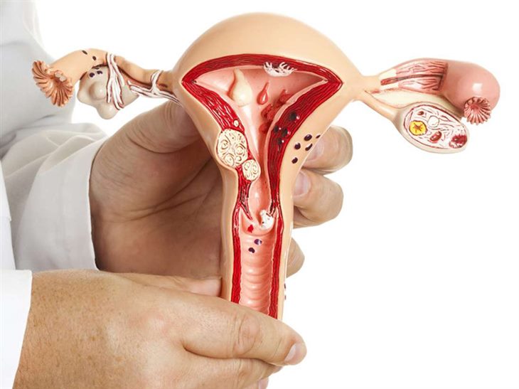 U xơ tử cung là nguyên nhân vô sinh ở nữ giới