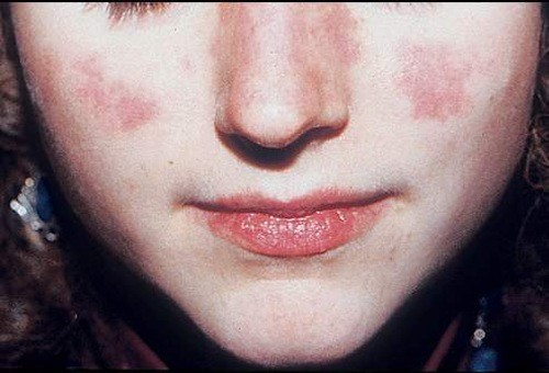Dấu hiệu dễ nhận biết nhất của lupus ban đỏ là nổi ban ở hai bên má