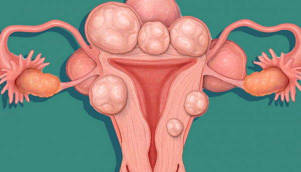U xơ tử cung là bệnh phụ khoa thường gặp