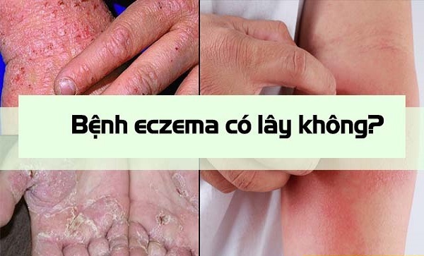 Eczema không có khả năng lây nhiễm từ người sang người