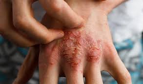 Bệnh eczema là gì?