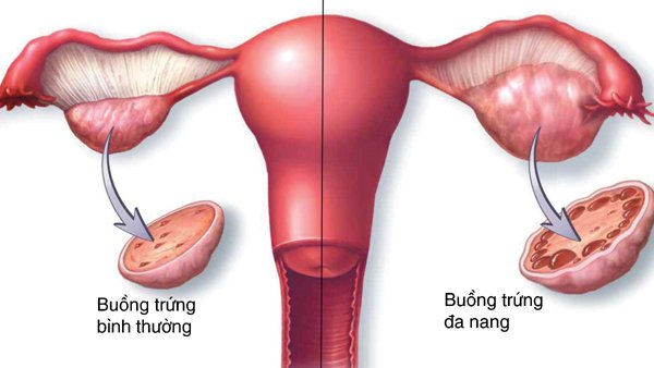 U nang buồng trứng gây vô sinh ở nữ giới