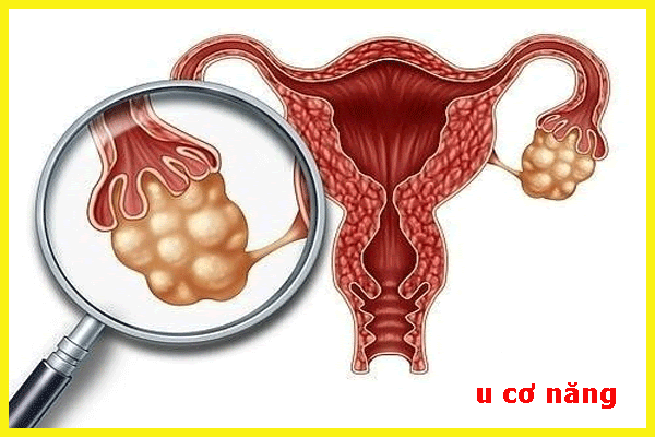 U nang cơ năng buồng trứng là bệnh phụ khoa lành tính   