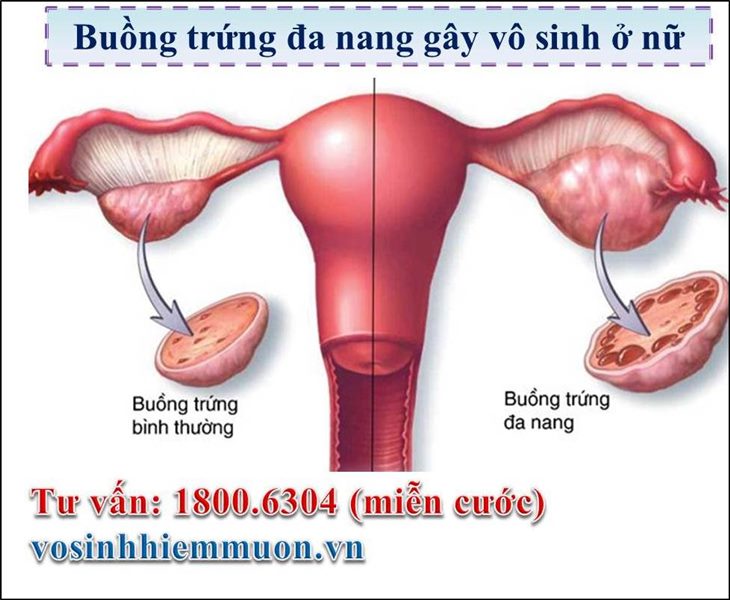 Buồng trứng đa nang có thể gây vô sinh ở nữ