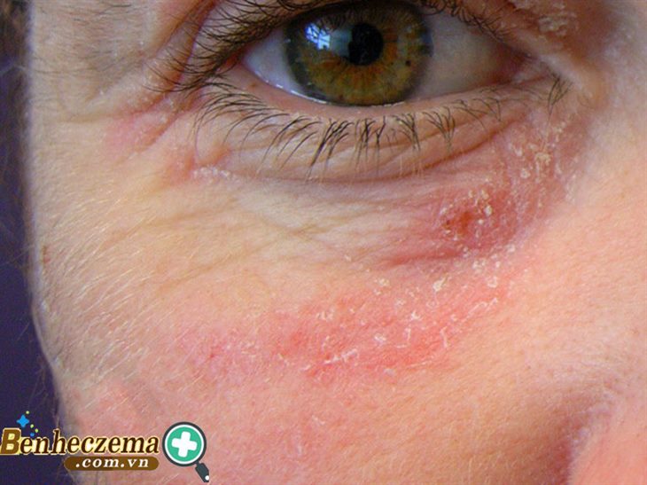Viêm da tiếp xúc dị ứng ở mặt là gì?