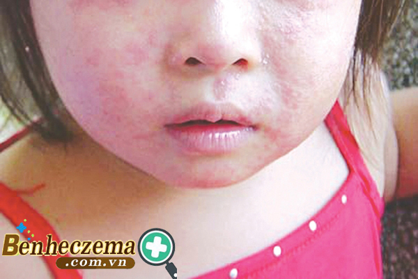  Hình ảnh bệnh chàm khô ở trẻ em