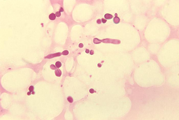Nấm Malassezia là một trong những nguyên nhân gây bệnh viêm da tiết bã