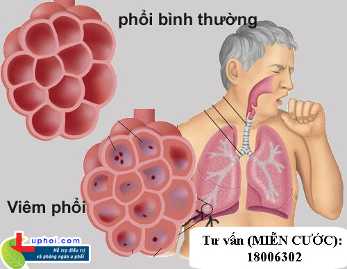 Bị viêm phổi thường xuyên có thể dẫn đến hình thành khối u phổi