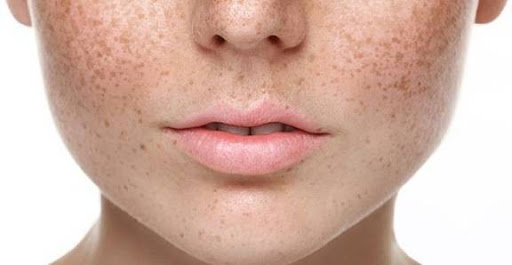   Tình trạng nám da thường xuất hiện trên mặt