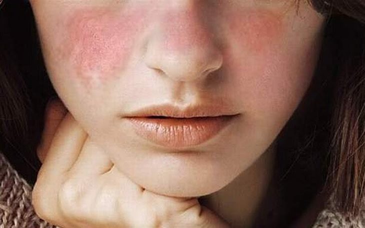 Lupus ban đỏ không phải bệnh truyền nhiễm