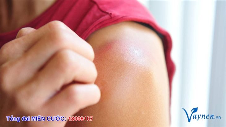 Tiếp xúc với ánh nắng (tia UV) có thể là một yếu tố hình thành bệnh lupus