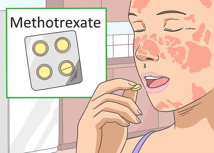 Methotrexate là thuốc điều trị vảy nến được sử dụng phổ biến