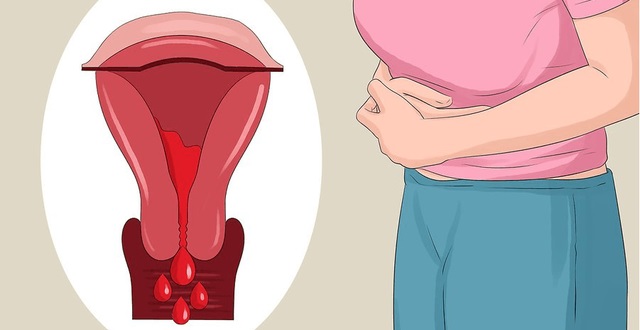 U lạc nội mạc tử cung khiến chị Thía đau bụng kinh dữ dội (Ảnh minh hoạ)