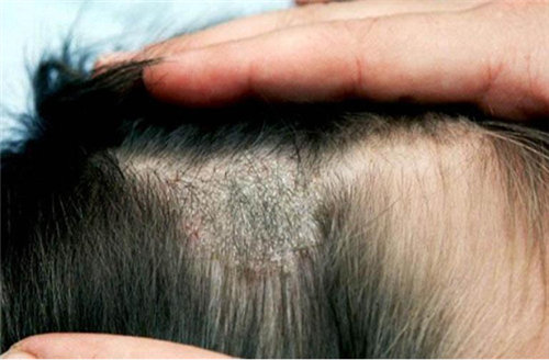   Triệu chứng của bệnh á sừng da đầu