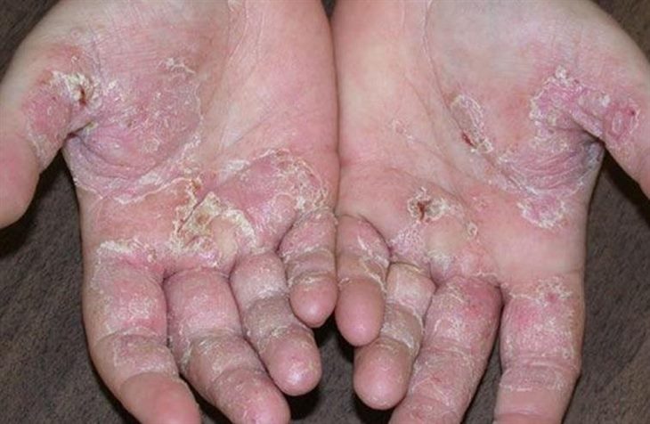  Bàn tay bị chàm (viêm da cơ địa, eczema) bội nhiễm (ảnh minh họa)