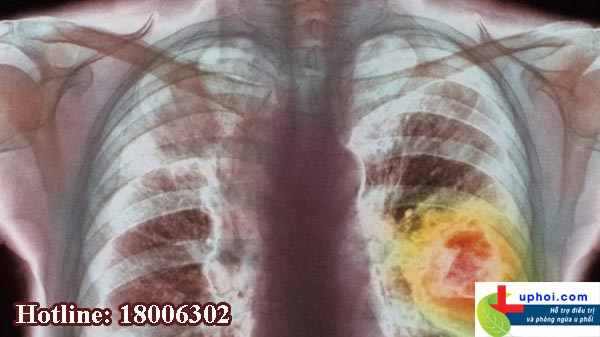 Ung thư phổi chủ yếu phát hiện ở giai đoạn muộn