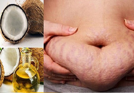   Cách chữa rạn da sau sinh bằng dầu dừa