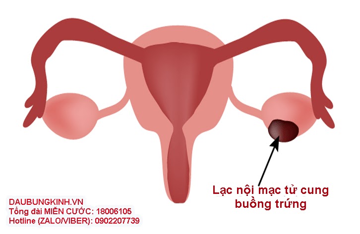 Lạc nội mạc tử cung buồng trứng thường xảy ra ở phụ nữ trong độ tuổi sinh sản