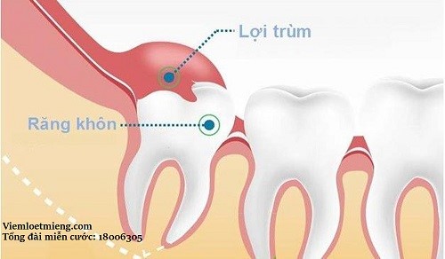 Viêm lợi trùm răng khôn là gì?