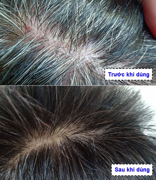 Cải thiện ở da đầu của anh Quốc trước và sau khi sử dụng Kim Miễn Khang & Explaq