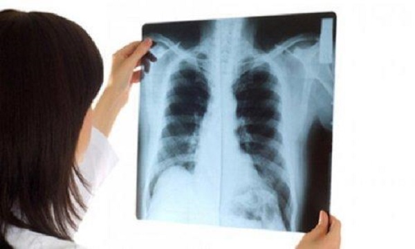 Chụp X - quang là xét nghiệm cần thiết trong chẩn đoán ung thư phổi