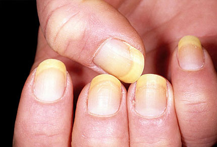 Móng nhiễm nấm là dấu hiệu của bệnh vảy nến móng tay