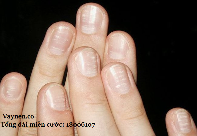 Rỗ móng là dấu hiệu của bệnh vảy nến móng tay