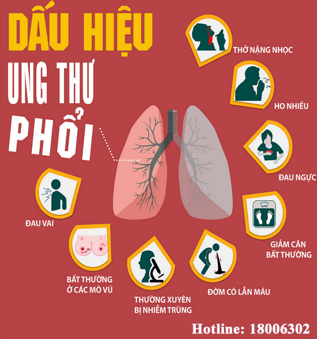Ung thư phổi có thể biểu hiện bằng nhiều triệu chứng