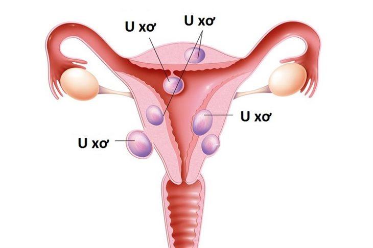 Hiện nay, tỷ lệ phụ nữ mắc u xơ tử cung ngày càng gia tăng