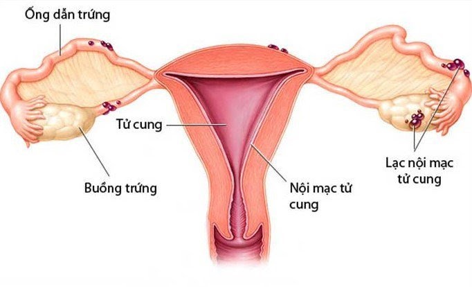 Lạc nội mạc tử cung là một bệnh lý phụ khoa nguy hiểm